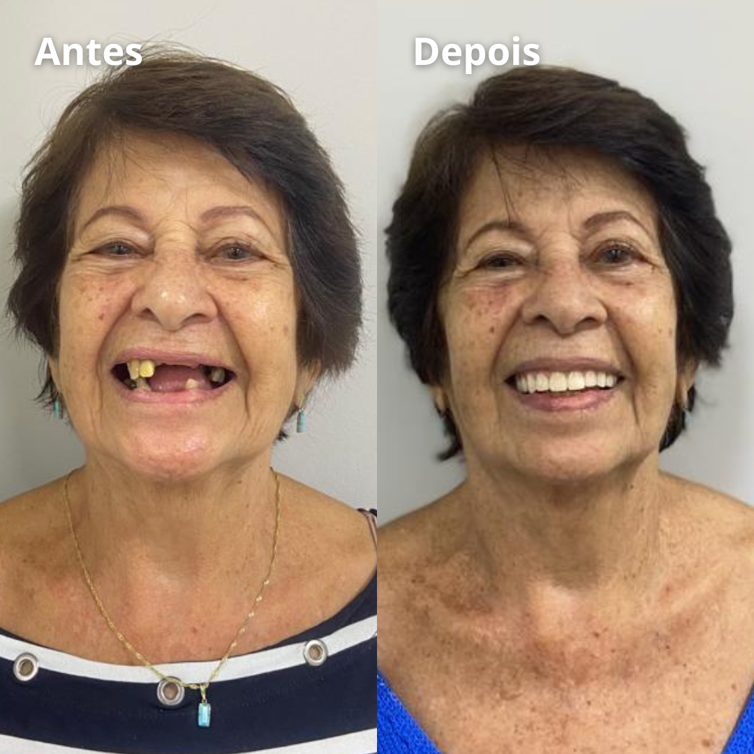 Implantes - Prótese - Facetas - Lentes - Clareamento - Aparelhos (1)
