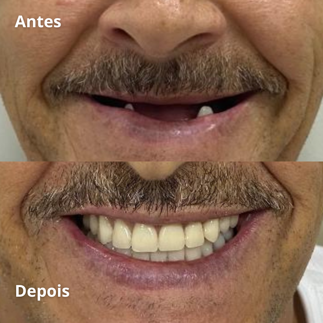 Implantes - Prótese - Facetas - Lentes - Clareamento - Aparelhos (2)