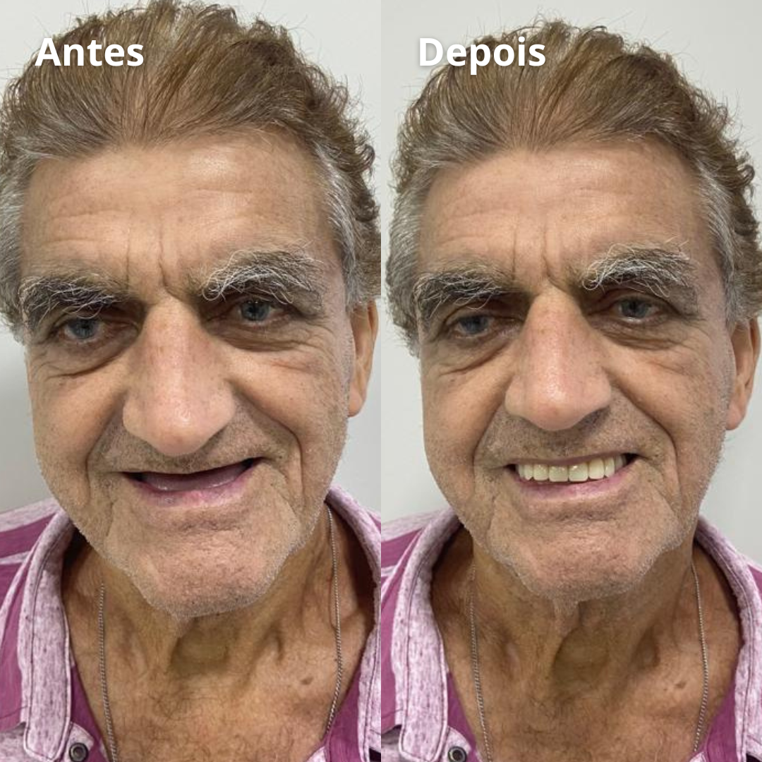 Implantes - Prótese - Facetas - Lentes - Clareamento - Aparelhos (3)