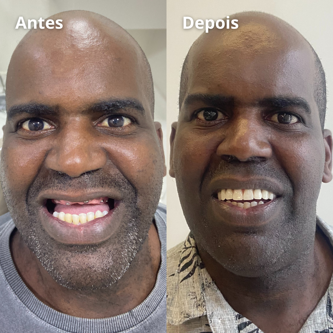 Implantes - Prótese - Facetas - Lentes - Clareamento - Aparelhos (4)